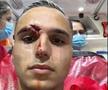 Desfigurat! FOTO-ȘOC din ambulanță: cum arată Cristi Manea, după faza care i-a îngrozit pe spectatorii din Gruia