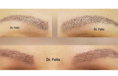 Intervențiile estetice, sportul femeilor - implant de sprâncene la Dr. Felix Hair Implant