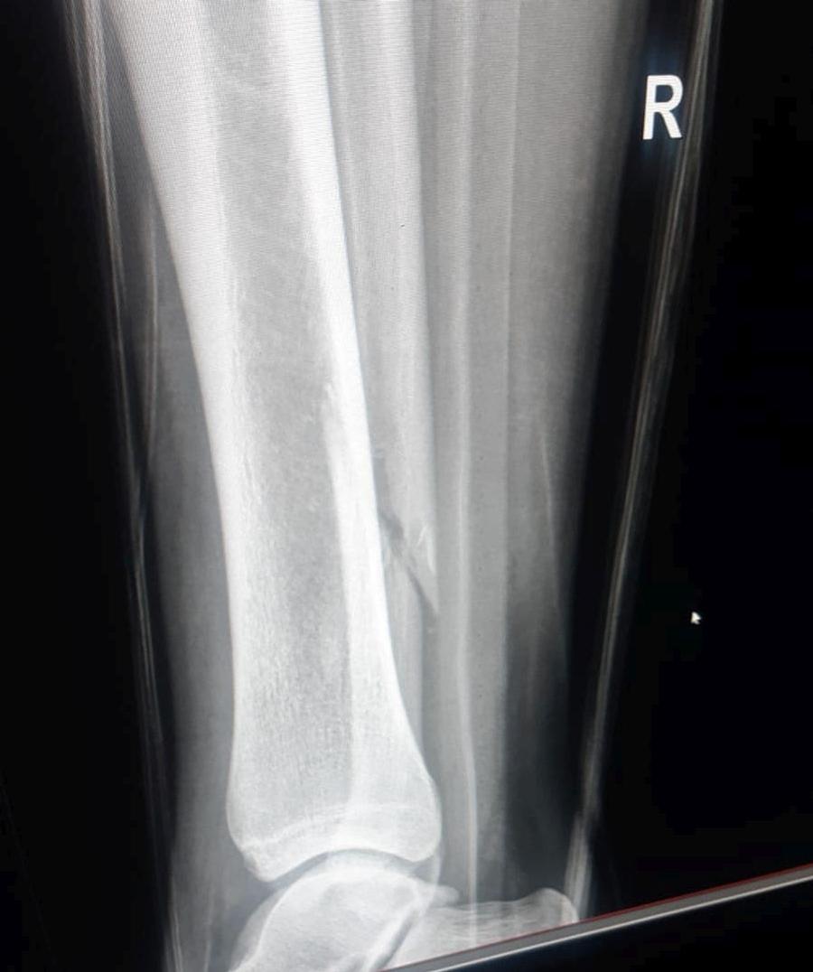 Radiografia lui Koljoc care arată fractura peroneului UPDATE VIDEO + FOTO Elvir Koljic, accidentare îngrozitoare în Craiova - Poli Iași! Cum arată radiografia jucătorului și care e diagnosticul