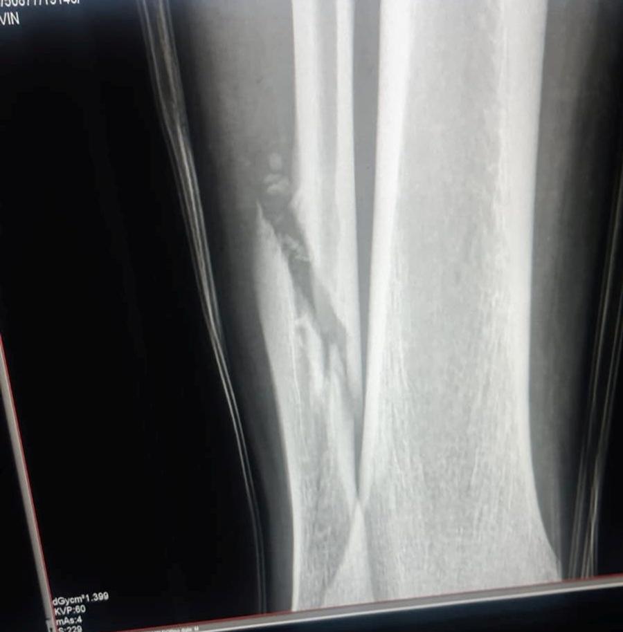 Radiografia lui Koljoc care arată fractura peroneului UPDATE VIDEO + FOTO Elvir Koljic, accidentare îngrozitoare în Craiova - Poli Iași! Cum arată radiografia jucătorului și care e diagnosticul
