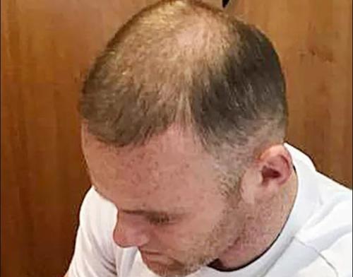 Așa arăta podoaba capilară a lui Wayne Rooney înaintea primului transplant de păr