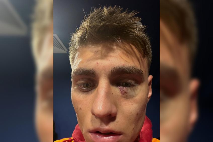 Kazimcan Karatas, lovit sub ochi cu o brichetă, în Fenerbahce - Galatasaray / Foto: Instagram