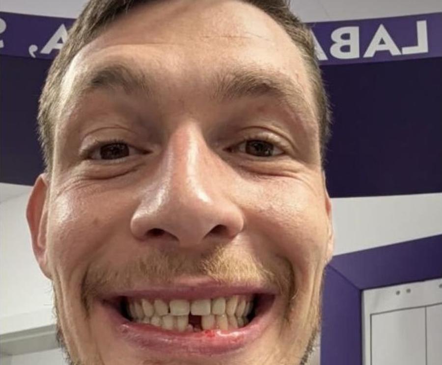 Andrea Belotti zâmbește, chiar dacă are dantura ruptă în partea de jos / Foto: Instagram @gallobelotti Andrea Belotti a rămas știrb după meciul din semifinalele Cupei Italiei. Reacția soției a devenit virală!