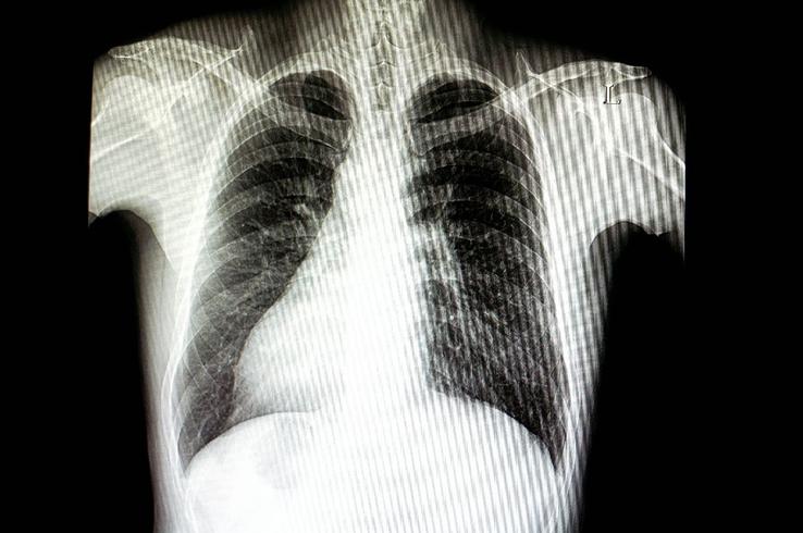 Situs inversus, anomalia congenitală în cadrul căreia anumite organe sunt situate în partea opusă față de situația normală / Sursă foto: Imago Images