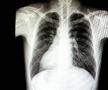 Situs inversus, anomalia congenitală în cadrul căreia anumite organe sunt situate în partea opusă față de situația normală / Sursă foto: Imago Images