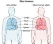 Situs inversus, anomalia congenitală în cadrul căreia anumite organe sunt situate în partea opusă față de situația normală / Sursă foto: Cleveland Clinic