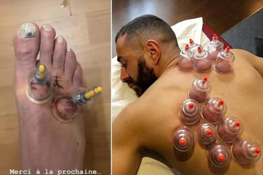 Și Karim Benzema s-a tratat cu ventuze pentru o mai bună refacere musculară / Foto: Instagram Imagine șocantă cu vârful de 44 de milioane! » Și-a acoperit tot corpul de ventuze