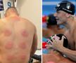 Tratamentul cu ventuze aplicate pe tot spatele a fost folosit și de alți sportivi / Foto: Instagram
