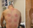 Și Karim Benzema s-a tratat cu ventuze pentru o mai bună refacere musculară / Foto: Instagram
