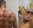 Louis Openda s-a tratat cu ventuze pentru o mai bună refacere musculară și eliminarea toxinelor din corp / Foto: Instagram