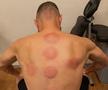 Și Karim Benzema s-a tratat cu ventuze pentru o mai bună refacere musculară / Foto: Instagram