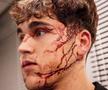 Greu de privit! Imagini HORROR cu fotbalistul Barcelonei » Cum arată după ce a fost șters cu crampoanele pe față în Liga Campionilor