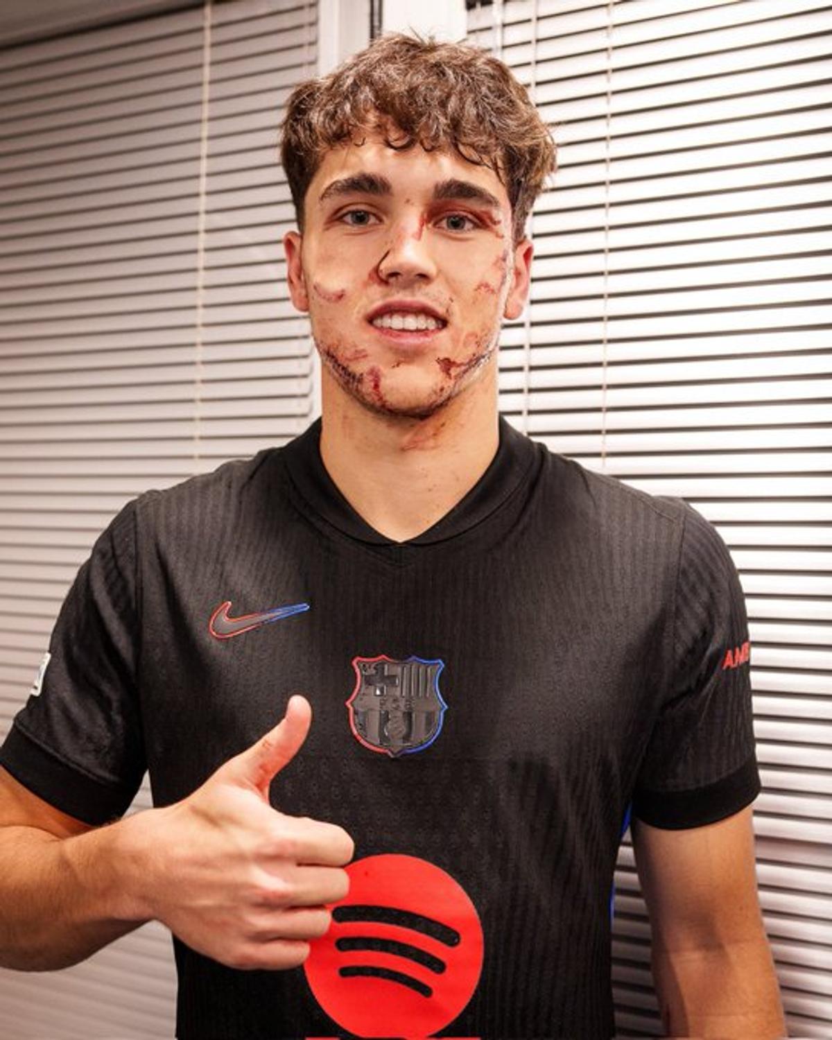 Greu de privit! Imagini HORROR cu fotbalistul Barcelonei » Cum arată după ce a fost șters cu crampoanele pe față în Liga Campionilor