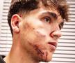 Greu de privit! Imagini HORROR cu fotbalistul Barcelonei » Cum arată după ce a fost șters cu crampoanele pe față în Liga Campionilor