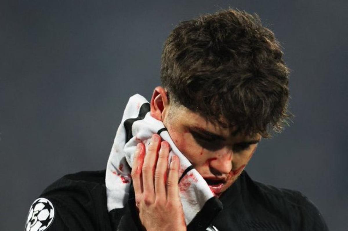 Greu de privit! Imagini HORROR cu fotbalistul Barcelonei » Cum arată după ce a fost șters cu crampoanele pe față în Liga Campionilor