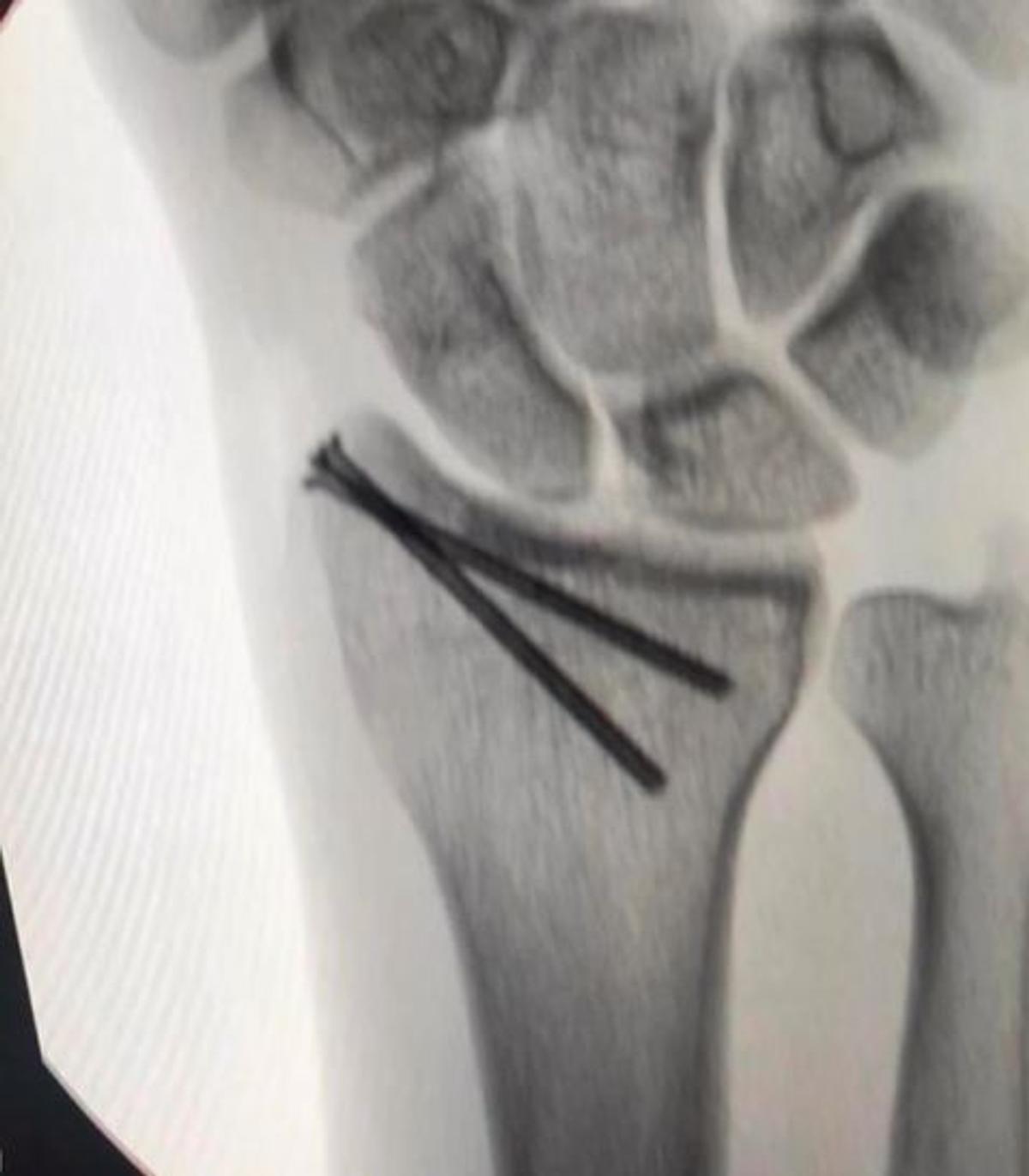 Calvarul prin care a trecut Lance Stroll pentru a lua startul în prima cursă de Formula 1 » Operat de urgență cu 12 zile înainte