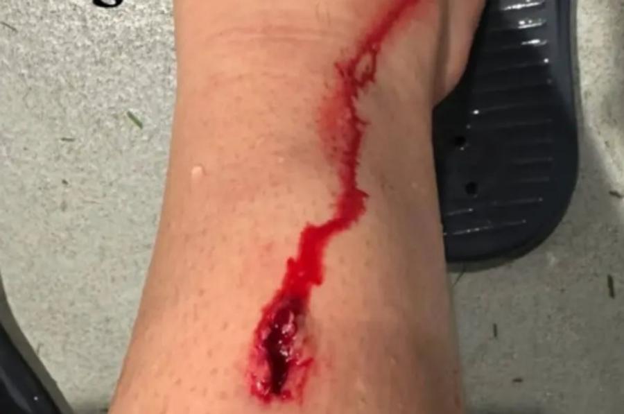 Tăietura provocată de Victor Lindelof lui Benat Prados / Foto: Instagram Atenție, imagini șocante! Jucătorul lui Bilbao acuză: „Fără cartonaș roșu, fără galben, fără fault, joacă...”