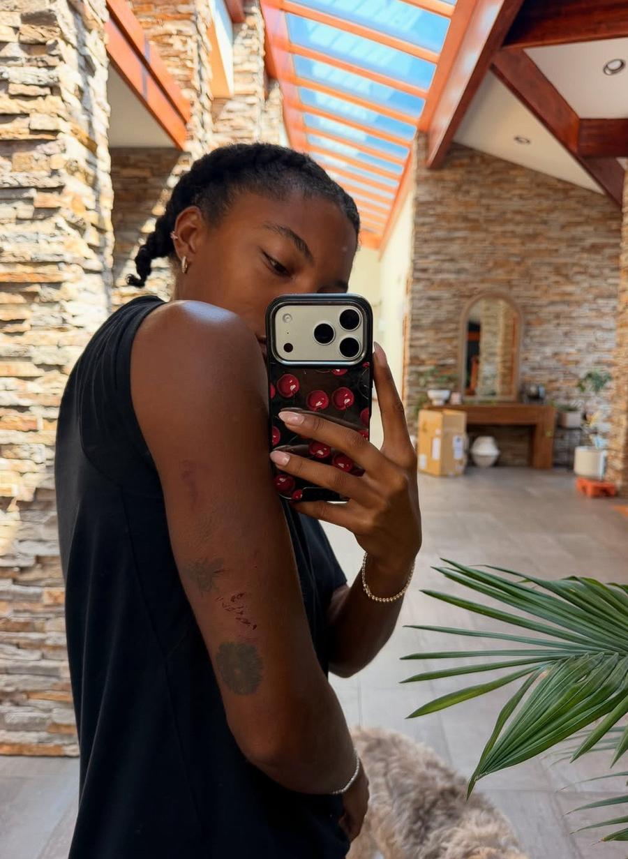 Rănile vizibile suferite de Tara Davis-Woodhall în urma coliziunii O campioană olimpică și mondială a fost nevoită să-și închidă sezonul din cauza unui accident de mașină