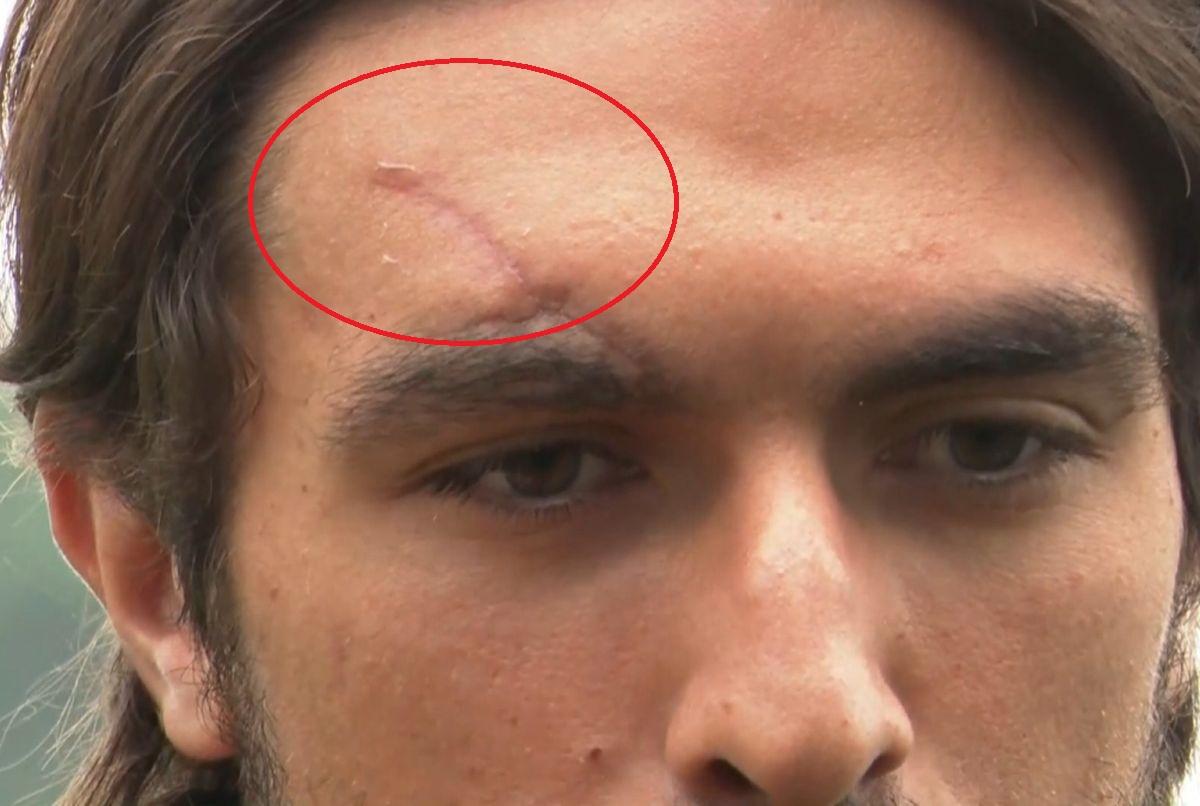 Cicatricea lui Andrea Compagno, după ciocnirea cu Darius Olaru