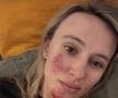 Katarzyna Niewiadoma - accidentare