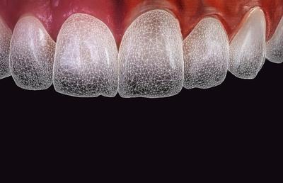 Faţete dentare şi inteligenţa artificială: o introducere în inovaţia stomatologiei