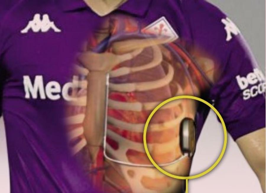 Aceasta este zona în care i s-a implantat defibrilatorul lui Edoardo Bove Anunțul medicilor pentru Edoardo Bove! » Mai poate reveni în teren mijlocașul italian de 23 de ani?