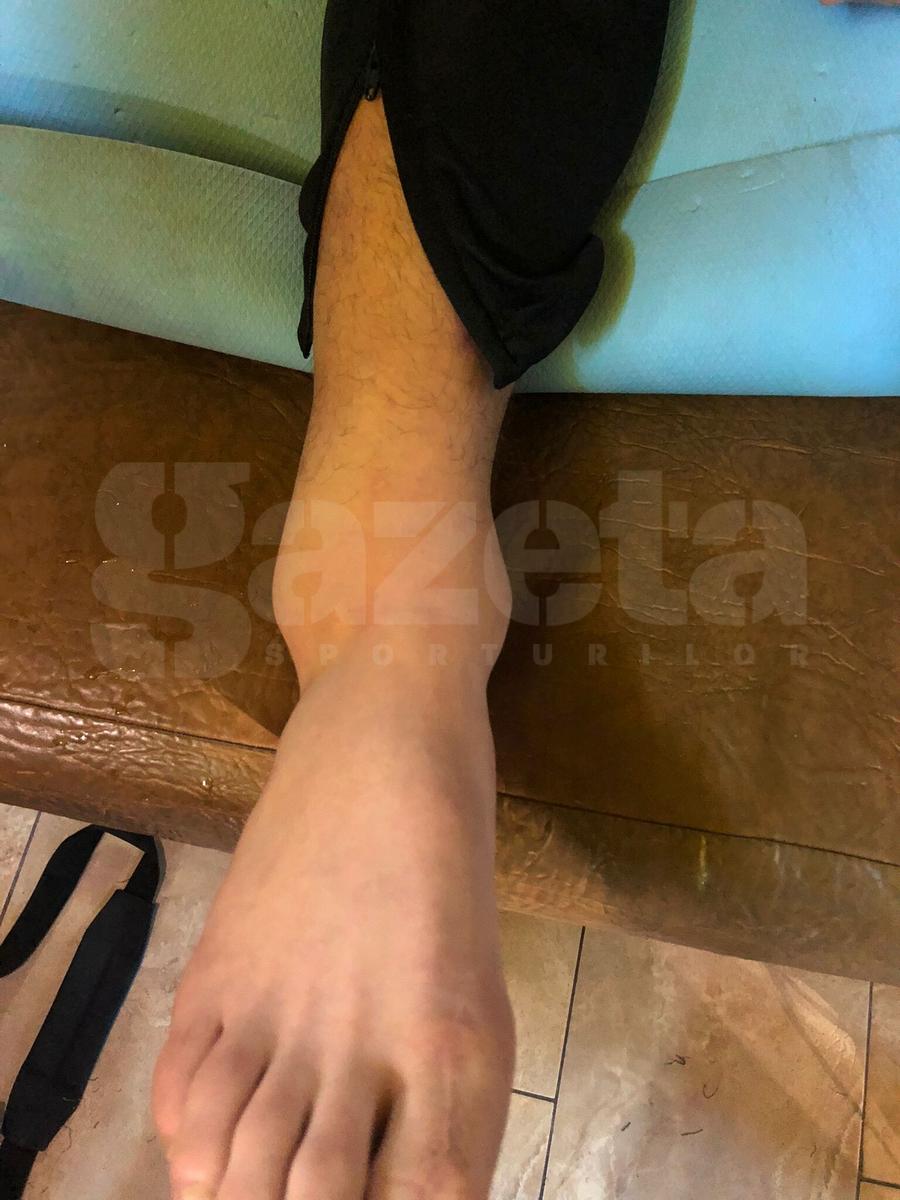 Anass Achahbar Cum arată piciorul lui Achahbar, după accidentarea din Rapid - Sepsi