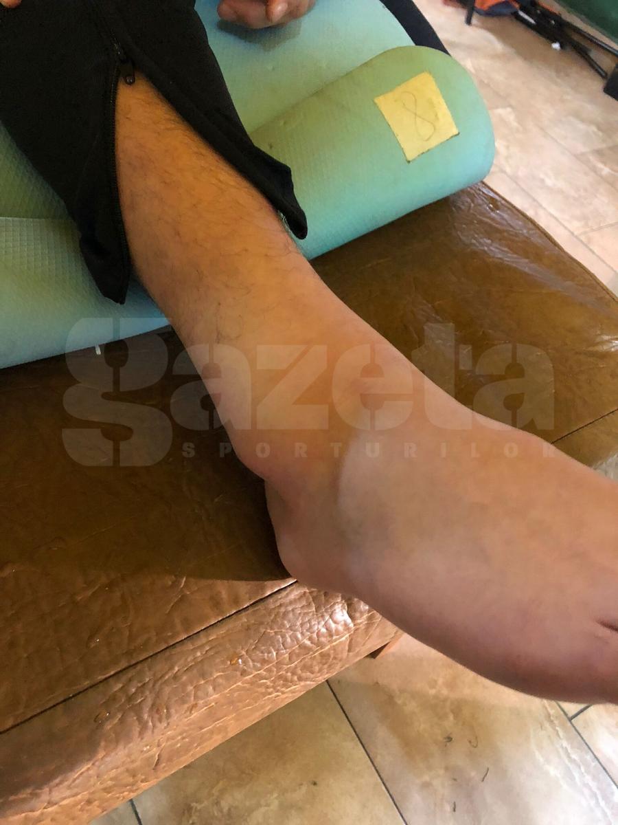 Anass Achahbar Cum arată piciorul lui Achahbar, după accidentarea din Rapid - Sepsi