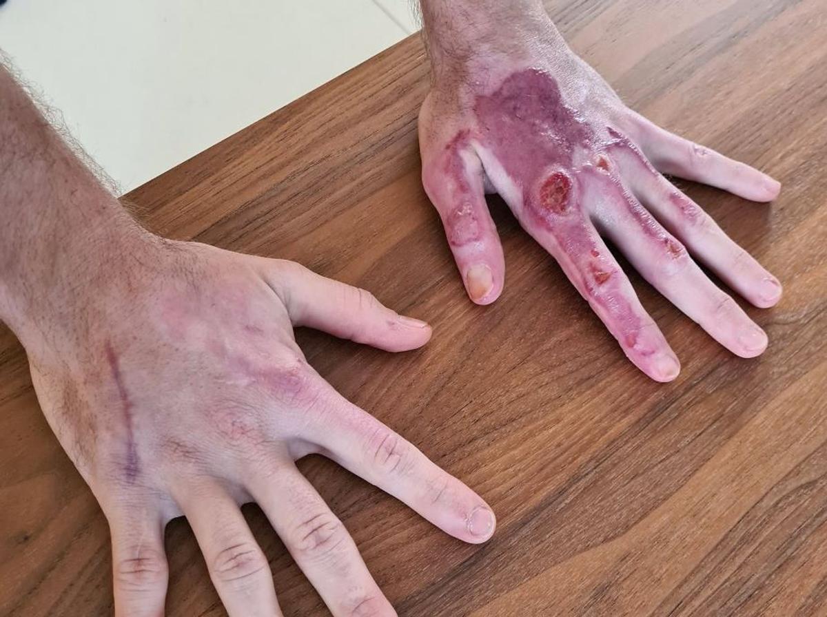 FOTO Imagini cu puternic impact emoțional » Mâinile lui Grosjean la două luni de la arsurile suferite în accidentul din Bahrain