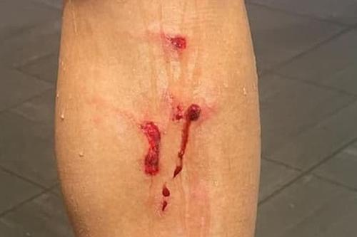Așa arăta gamba stângă a lui Minamino după tacklingul lui Dante