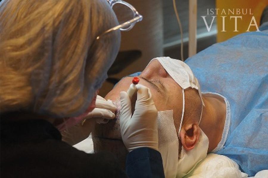 Implant de păr Turcia - Cel mai bun centru IstanbulVita