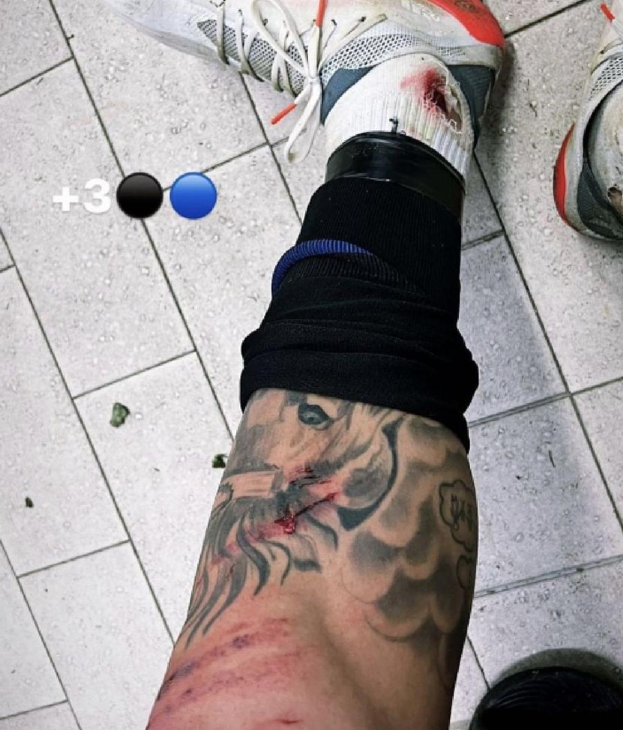 Parcă s-a bătut în UFC! Cum arată piciorul mijlocașului român care e pe val în Italia