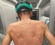 HORROR » O furtună cu gheață a lovit cursa ciclistă Criterium du Dauphine, iar unii cicliști au suferit răni severe
