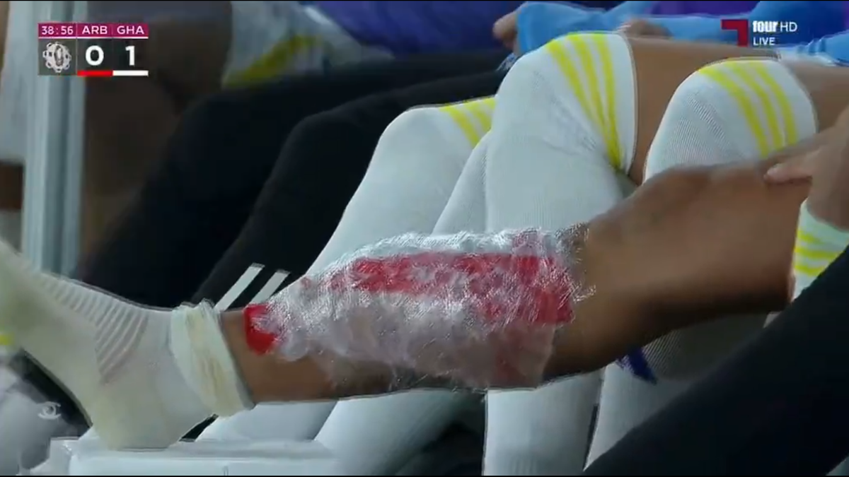 Piciorul lui Florinel Coman după accidentarea din Al Arabi - Al Gharafa