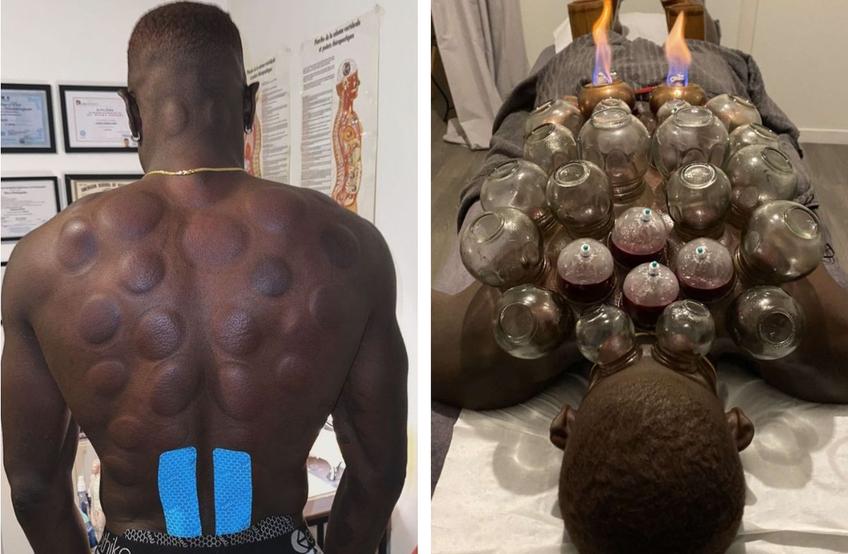 Joyskim Dawa (27 de ani), fundașul central al celor de la FCSB, a postat imagini spectaculoase din timpul terapiei de „fire cupping”.