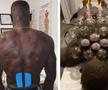 Joyskim Dawa (27 de ani), fundașul central al celor de la FCSB, a postat imagini spectaculoase din timpul terapiei de „fire cupping”.
