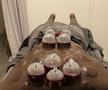 Joyskim Dawa, terapie prin cupping