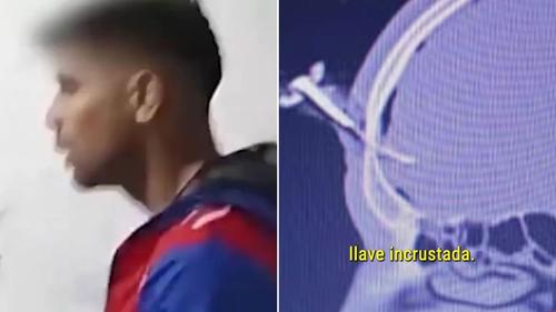 Jonathan Smith și radiografia craniului său străpuns de cheie