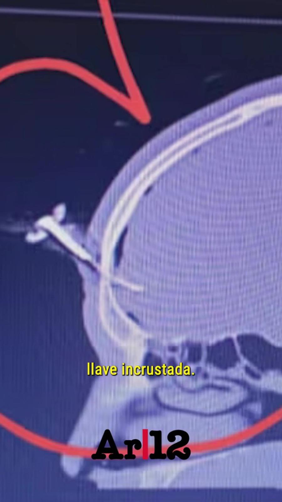 Radiografia teribilei răni suferite de mijlocașul argentinian Operat pentru a-i fi extrasă o cheie de mașină înfiptă în cap! Imagini șocante