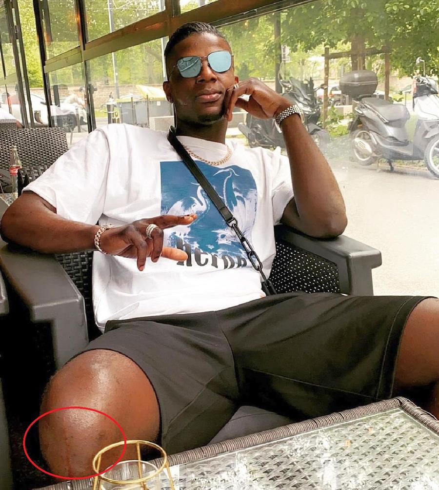 Urmele operațiilor se văd pe genunchiul drept al lui Eddy Gnahore / Sursă foto: Instagram A ținut-o din operație în operație! 5 lucruri despre cel mai nou transfer făcut de Dinamo: declinul a început în China