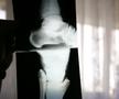 Radiografia de la piciorul afectat /  Sursă foto: Arhivă GSP
