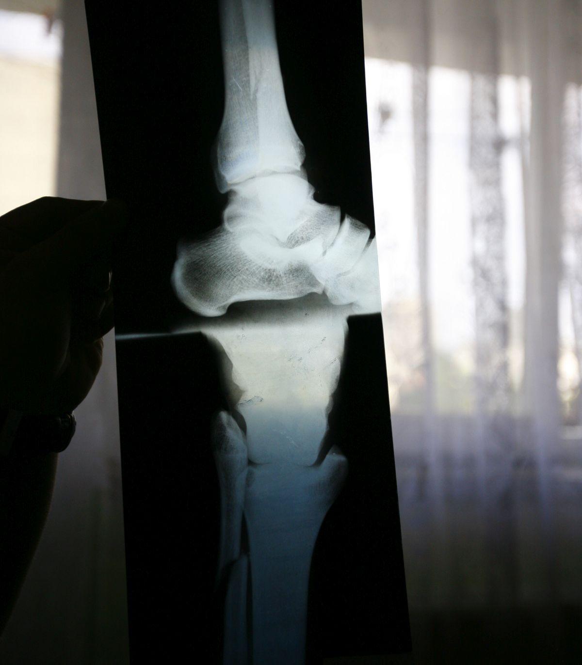 Monel Cârstoiu - imagini cu fostul mijlocaș al Argeșului, accidentat grav de Alex Pițurcă în 2008