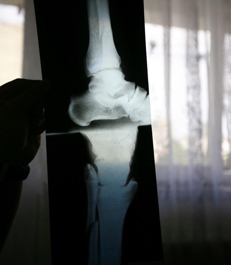 Radiografia de la piciorul afectat /  Sursă foto: Arhivă GSP