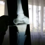 Radiografia de la piciorul afectat /  Sursă foto: Arhivă GSP