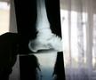 Radiografia de la piciorul afectat /  Sursă foto: Arhivă GSP
