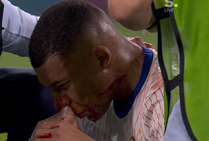 Mbappe, cu nasul spart, a fost scos de pe teren în finalul meciului cu Austria