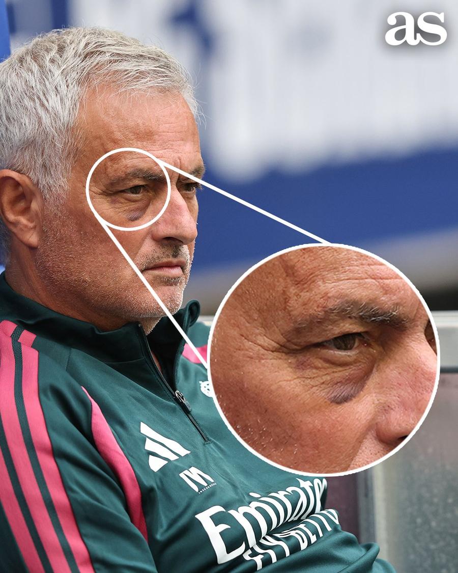 Jose Mourinho și vânătaia de sub ochiul drept / Foto: X AS Jose Mourinho, cu ochiul vânăt la amicalul lui Real Madrid