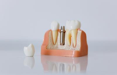 Cum găsești cea mai bună clinică stomatologică din Iași pentru Tratamentul cu Implant Dentar
