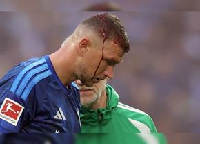 Edin Dzeko, rană deschisă la cap!  » Medicul a cerut înlocuirea