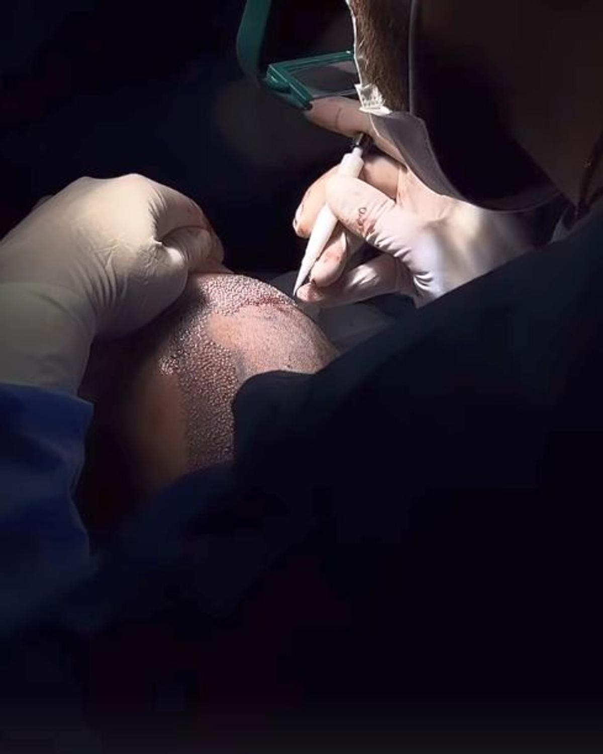 Adrian Mutu și-a făcut implant de păr